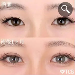 TCBの二重整形症例②