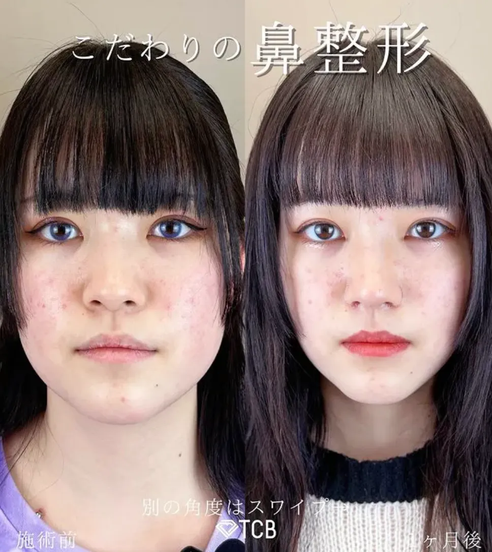 TCBの鼻整形の症例写真