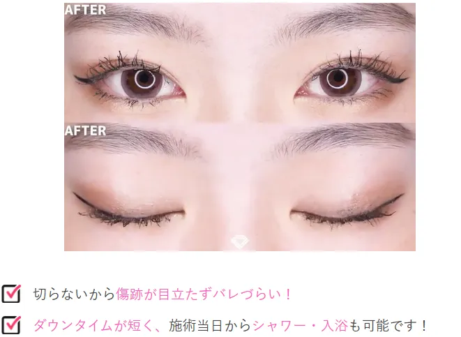 TCB二重術はバレにくい