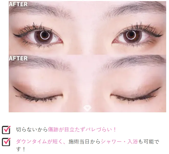 TCB二重術は切らない施術だからばれにくい