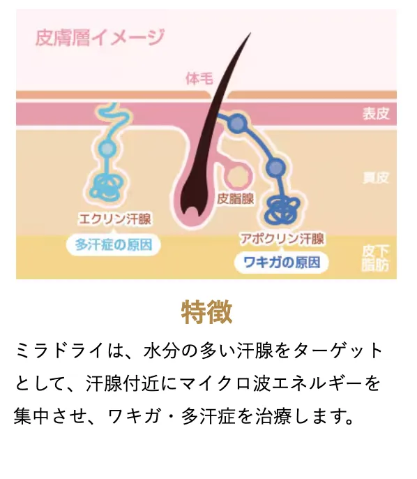 ミラドライの特徴