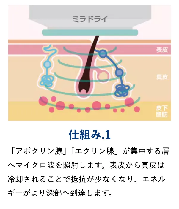 ミラドライの仕組み１