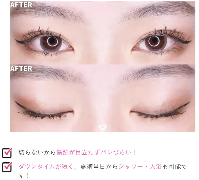 TCB二重術はばれにくい