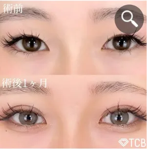 TCBの二重整形症例②