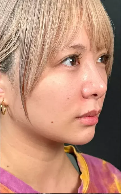 糸リフト①-1