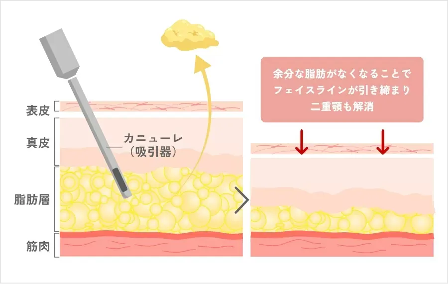 Tクリニックの脂肪吸引について