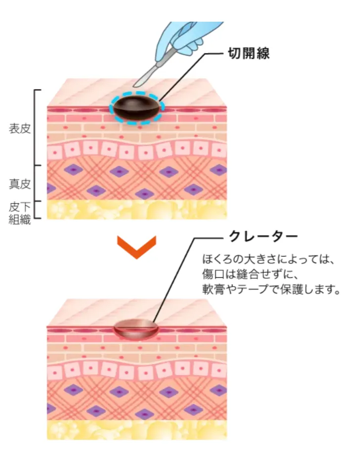 仙台でほくろ除去がおすすめのTCBの切開法