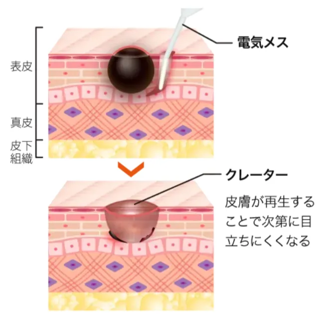 仙台でほくろ除去がおすすめのTCBの電気メス法