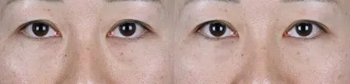 横浜で安いおすすめモフィウス8の症例写真3