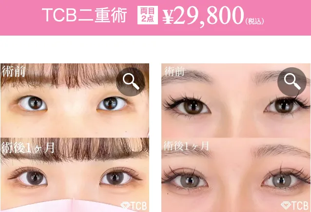 TCB二重施術後の画像