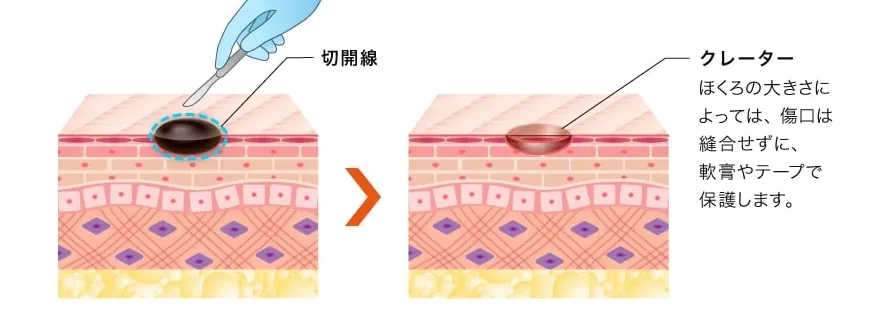 沖縄でほくろ除去がおすすめクリニック TCBのLP画像