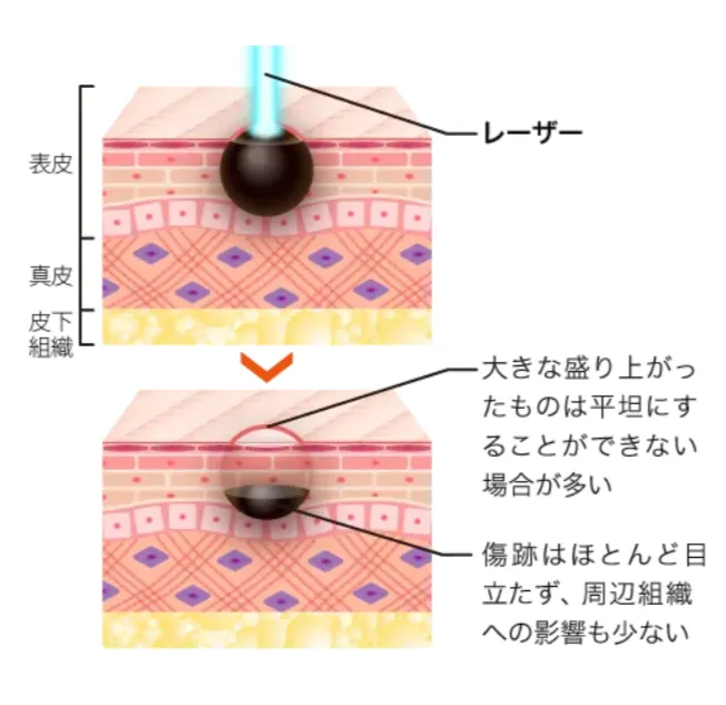 仙台でほくろ除去がおすすめのTCBのレーザー法