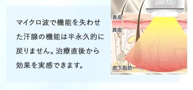 ミラドライが安いおすすめのクリニック 共立美容外科の治療