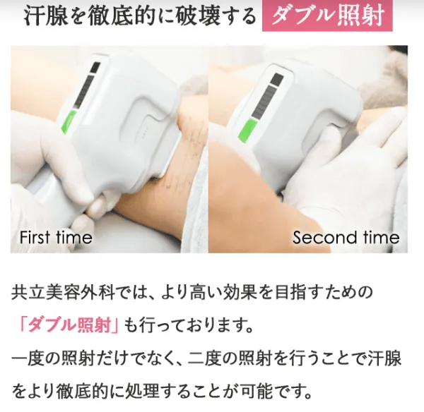 ミラドライが安いおすすめのクリニック 共立美容外科のダブル照射