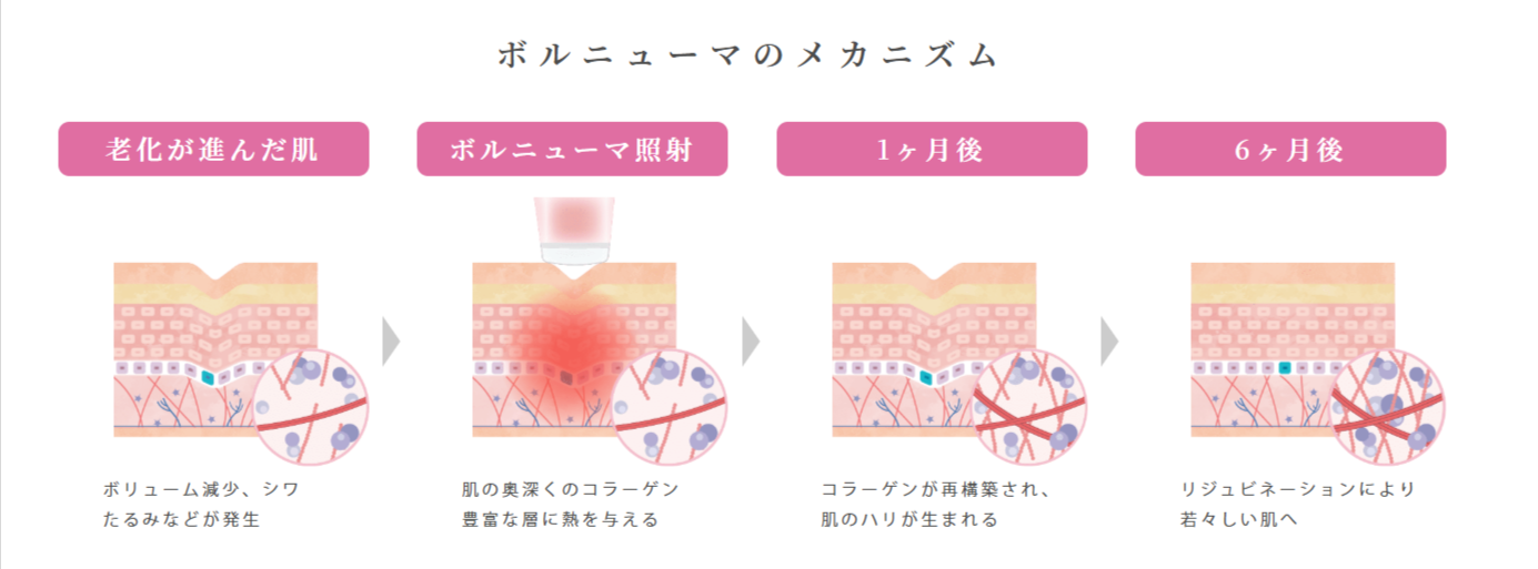 ボルニューマのメカニズム