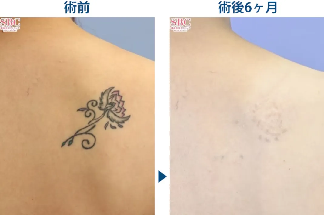 仙台で安いタトゥー除去がおすすめな湘南美容クリニックの症例写真