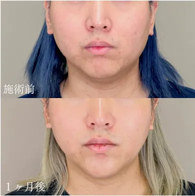 TCBの脂肪吸引症例