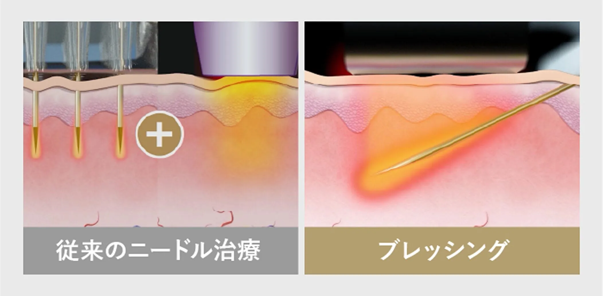 TAクリニックのブレッシングについて