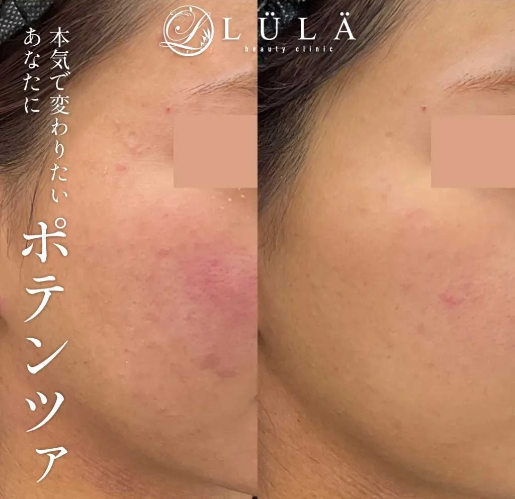 千葉でポテンツァが安いおすすめのルラ美容クリニック 症例写真