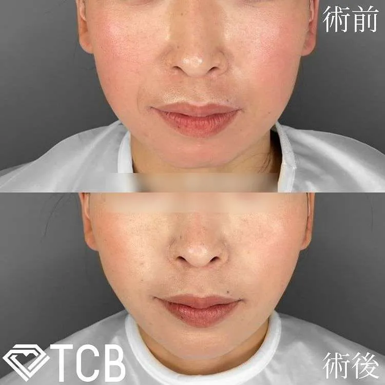 TCBの糸リフトの症例
