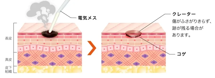 沖縄でほくろ除去がおすすめクリニック TCBのLP画像