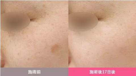 湘南美容クリニックのシミ取り放題(ピコスポット)症例