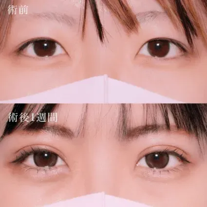 TCBの二重整形の症例