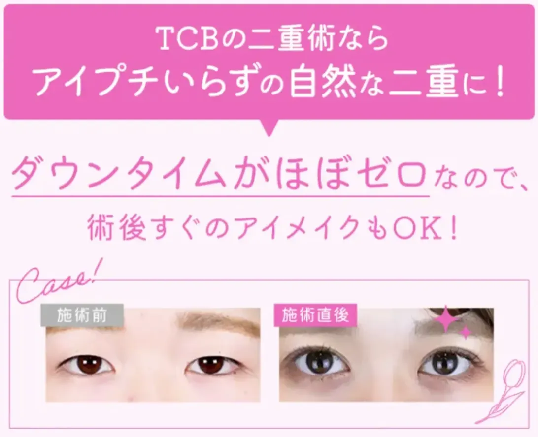 TBCの二重埋没　福岡