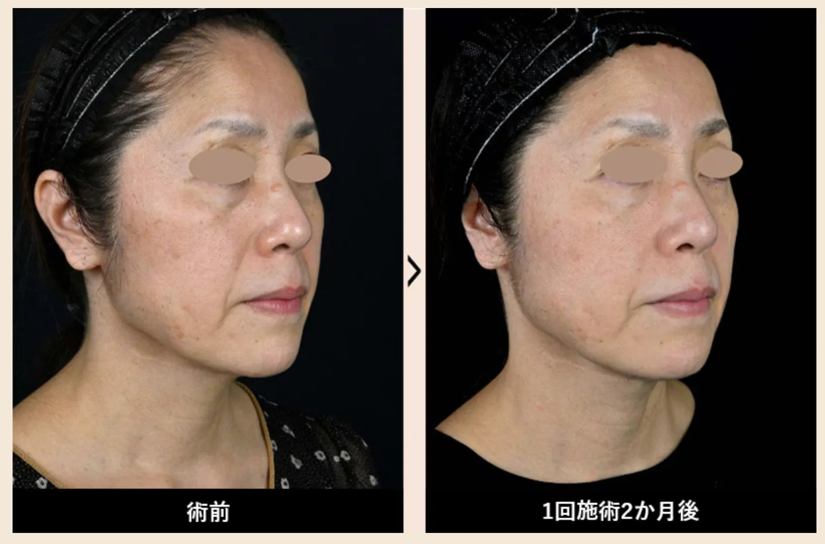 福岡で安いプロファイロがおすすめの湘南美容クリニック 症例写真②