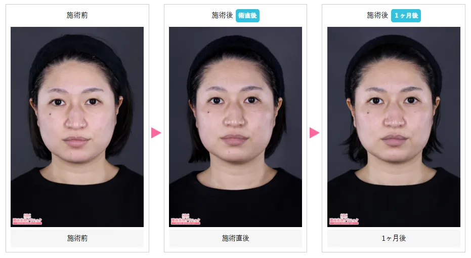 沖縄で医療ハイフが安い湘南美容クリニックの症例写真①