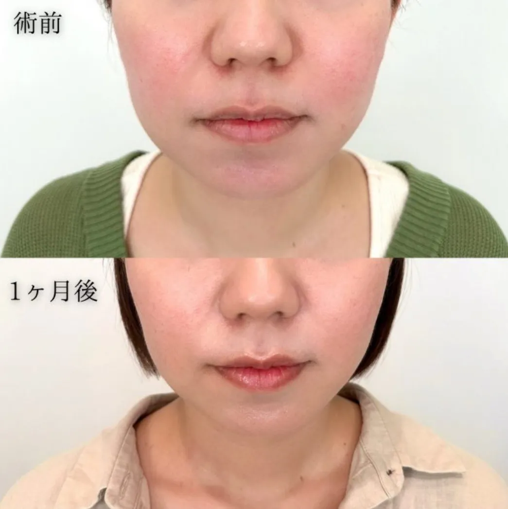 TCBハイフの症例①