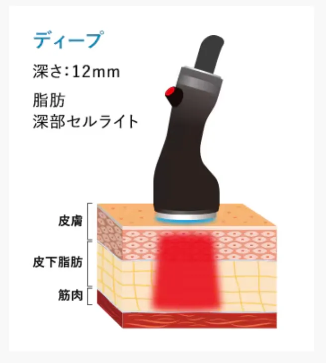 湘南美容クリニックでオンダリフトで使用するハンドピースのディープ