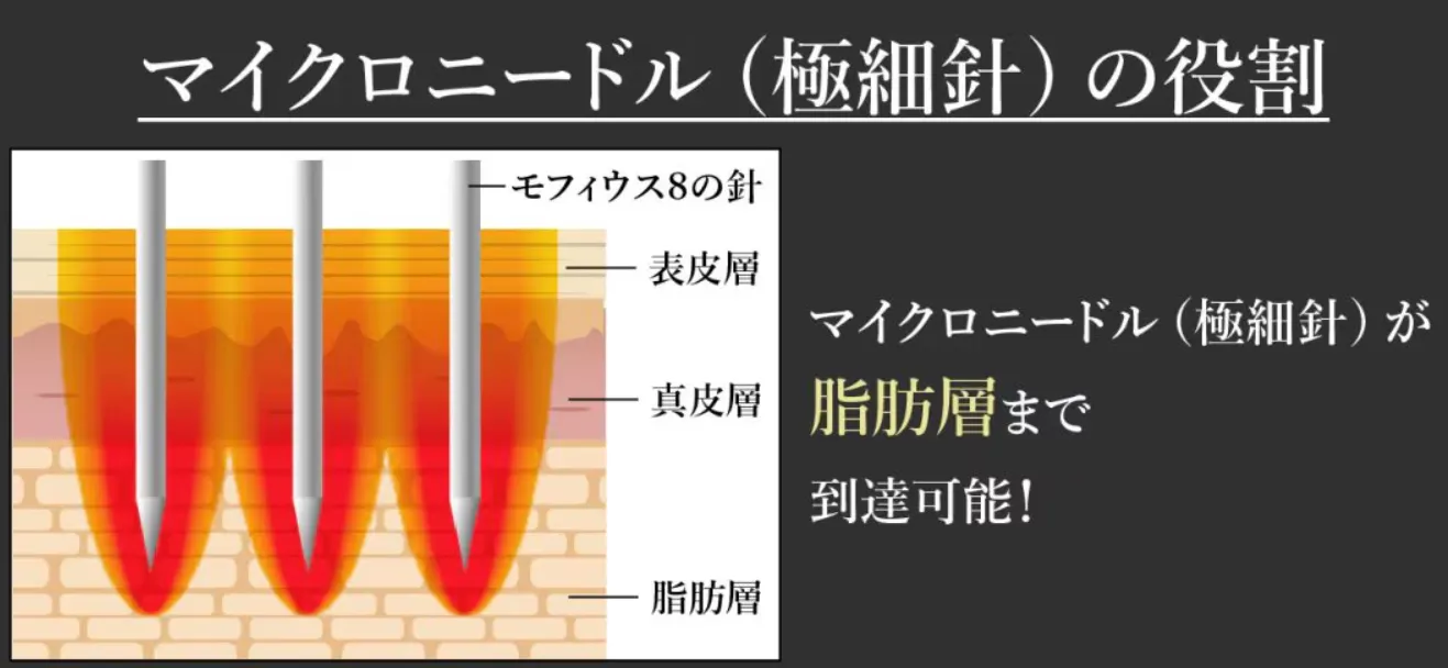神戸でおすすめの安いモフィウス８のマイクロニードルの役割SCB