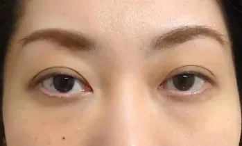 高知でクマ取りがおすすめのクリニック　茶クマ