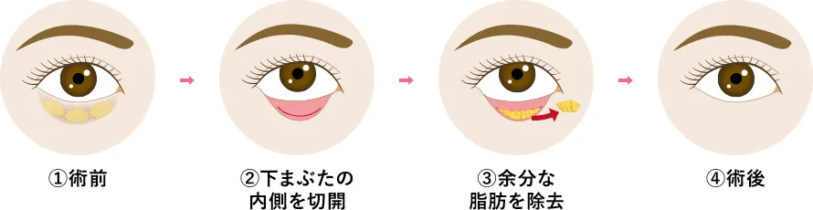 口コミ評判の良い湘南美容クリニックの脱脂の施術方法