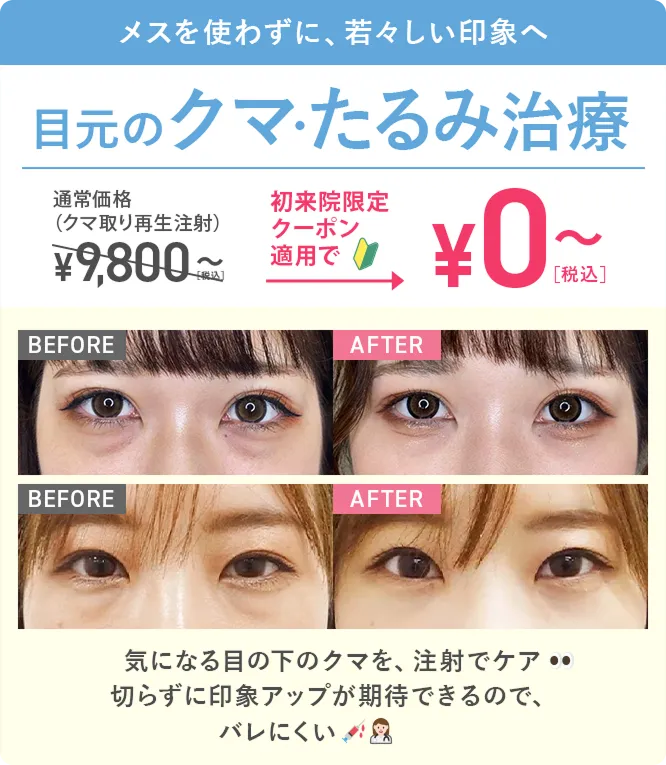 TCBのクマ取り　通常価格9,800円が初回限定で0円～