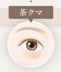 埼玉でクマ取りがおすすめのクリニック 茶クマ画像