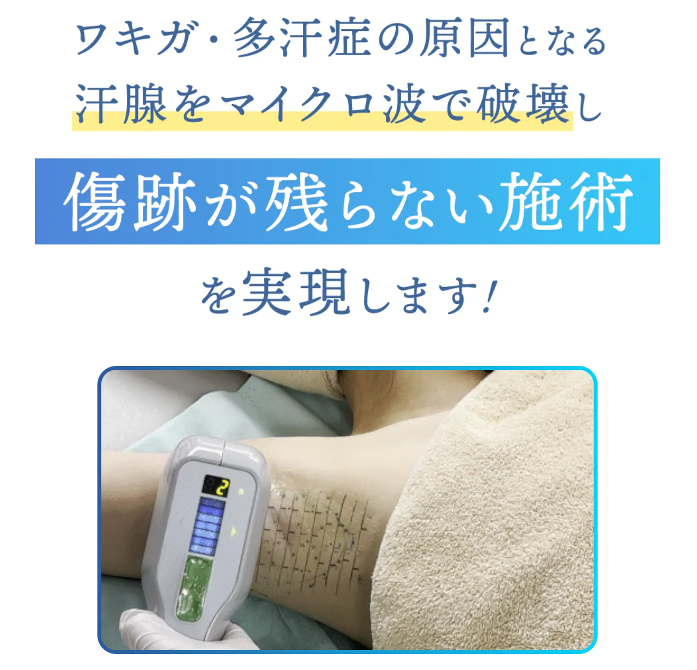 共立美容外科のミラドライダブル照射とは? 傷跡が残らない