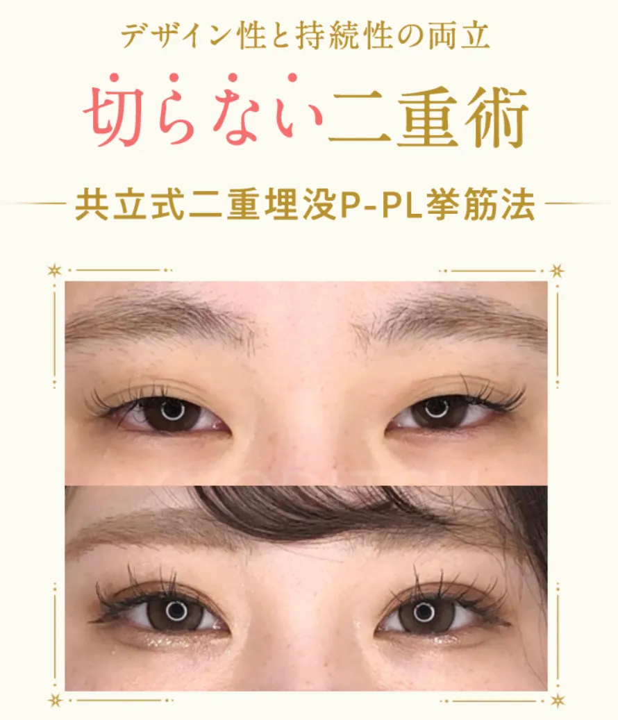 共立美容外科のP-PL挙筋法(埋没法)は切らない施術