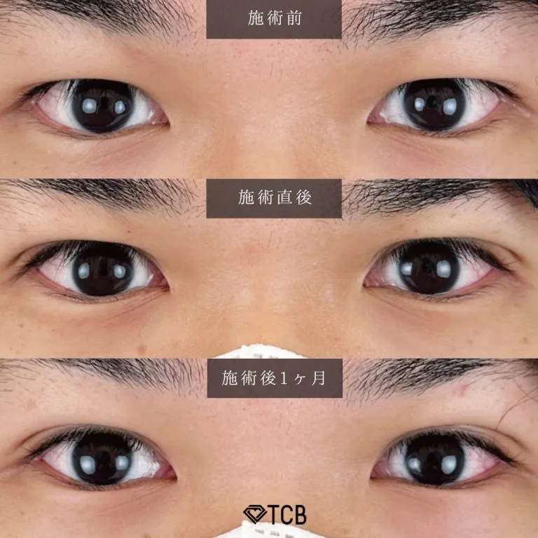 男性・メンズの二重整形の症例写真