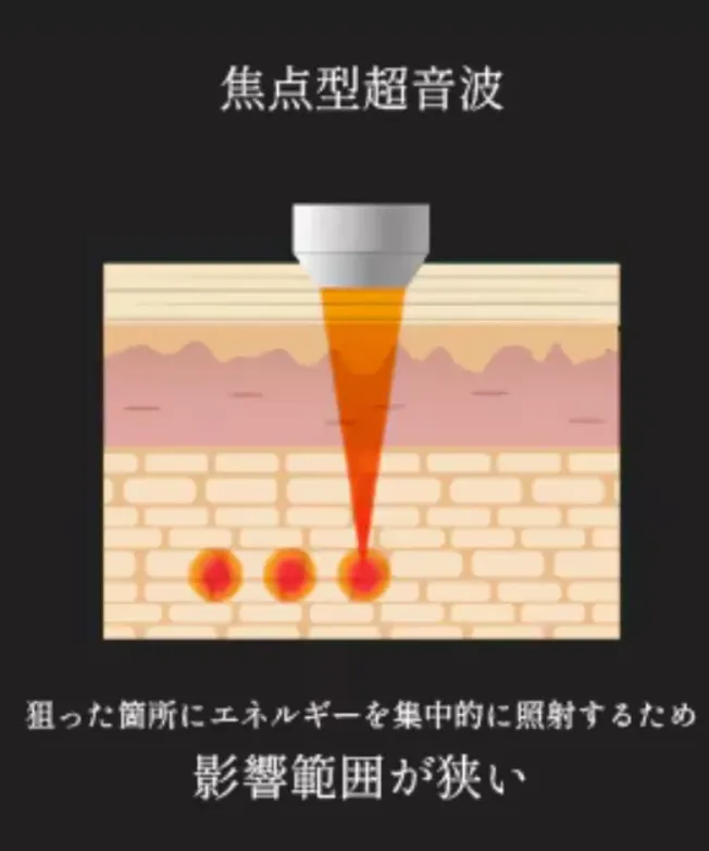 湘南美容クリニックのモフィウス8は狙った箇所にエネルギーを集中的に照射できる