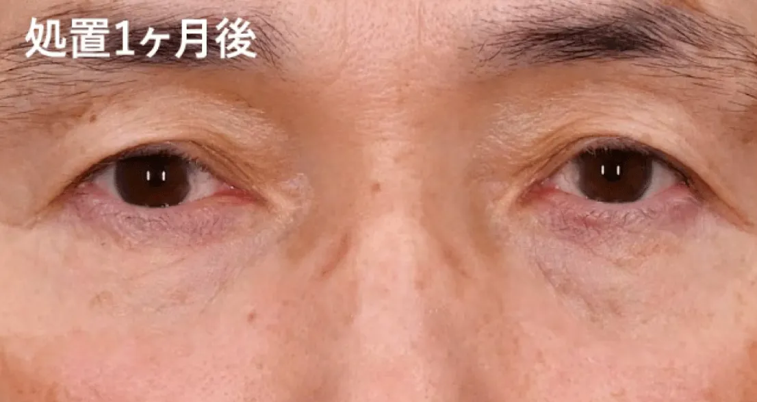 湘南美容クリニックのモフィウス8の処置1か月後の症例画像