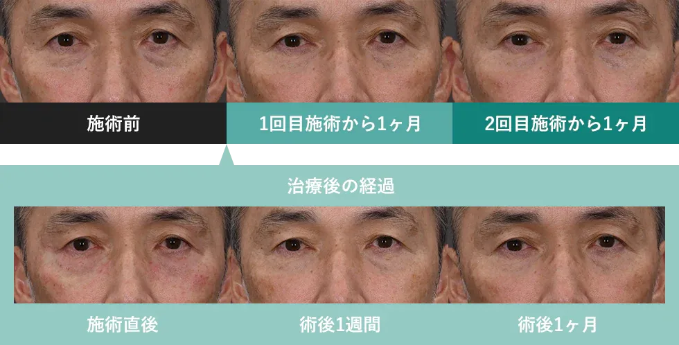 効果を期待できるモフィウス8が受けられる湘南美容クリニックの症例④