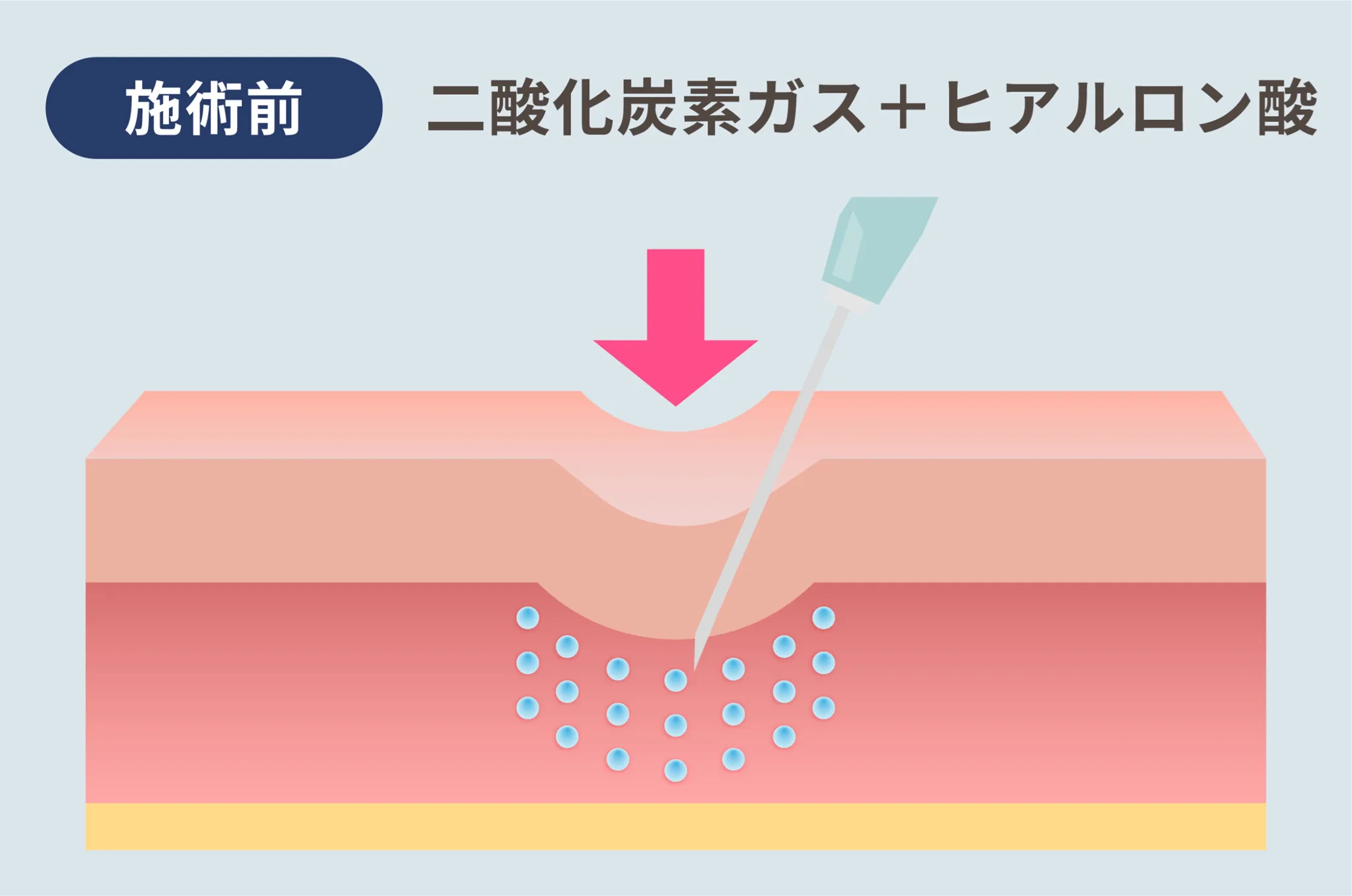 名古屋でジュブゼンが安いおすすめのクリニック　ライブリークリニックの施術方法①