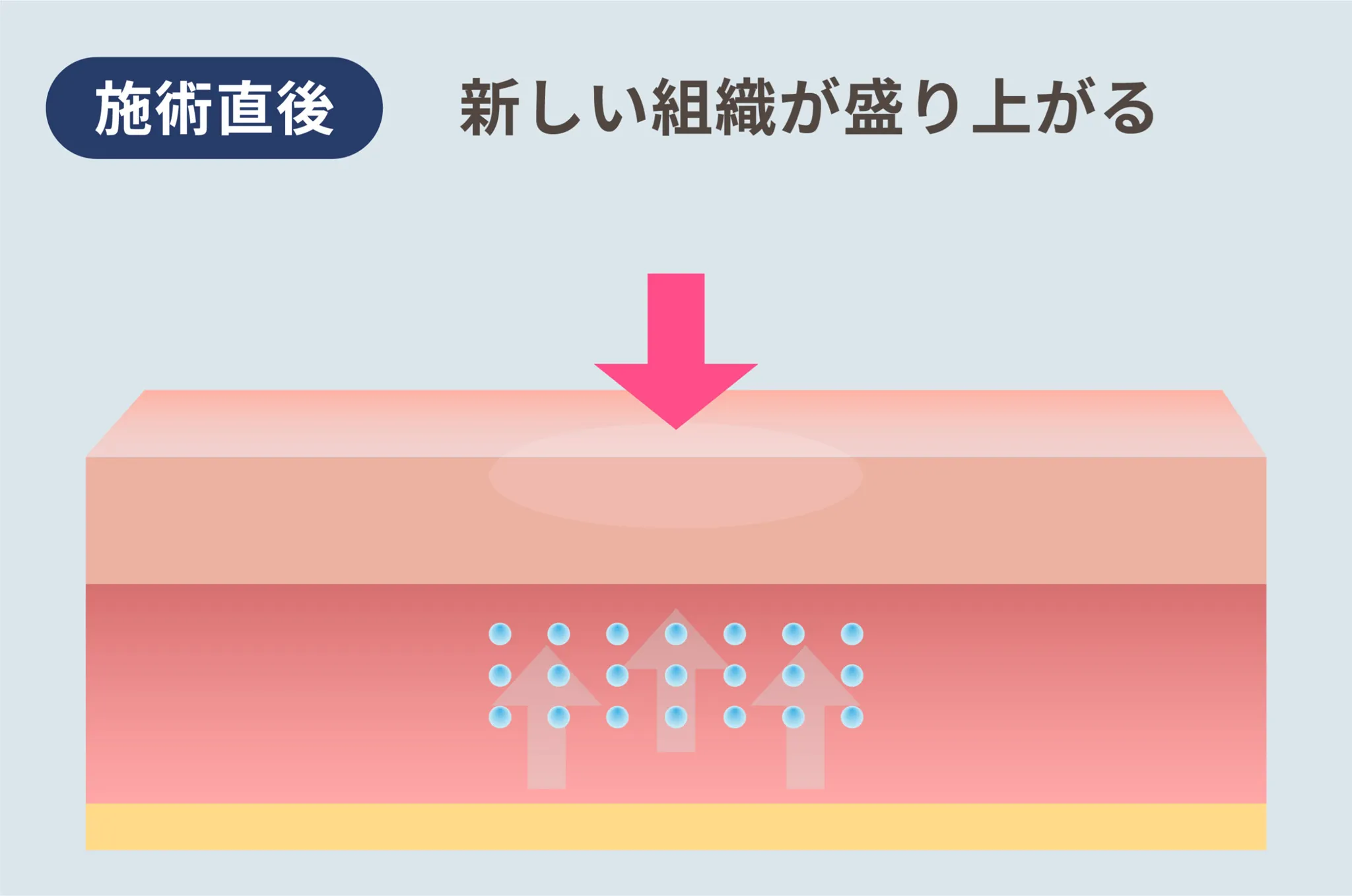 名古屋でジュブゼンが安いおすすめのクリニック　ライブリークリニックの施術方法②