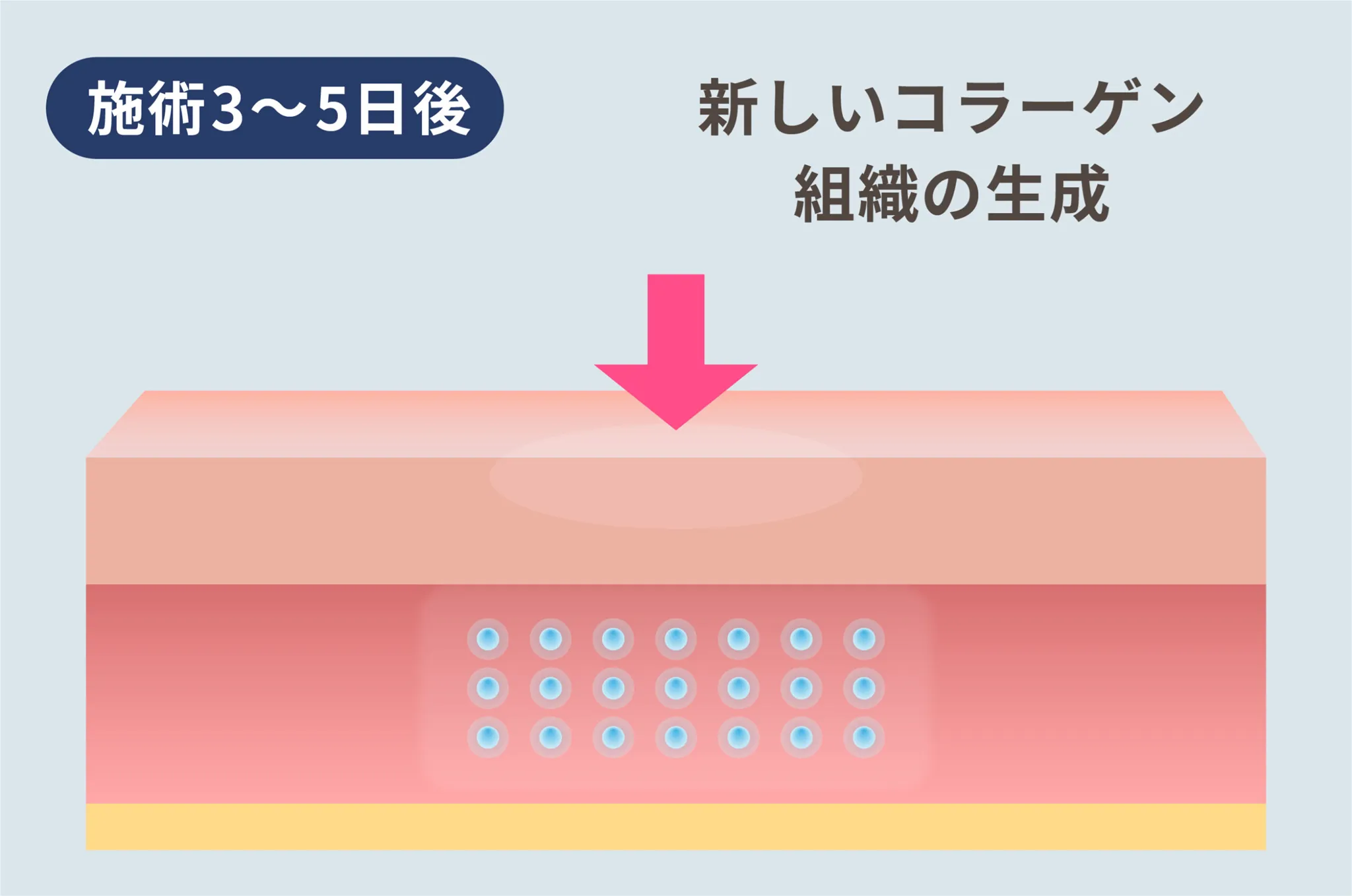 名古屋でジュブゼンが安いおすすめのクリニック　ライブリークリニックの施術方法③