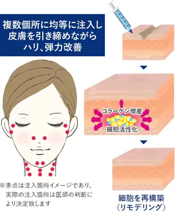 名古屋でプロファイロが安いおすすめのクリニック 湘南美容クリニックの施術方法