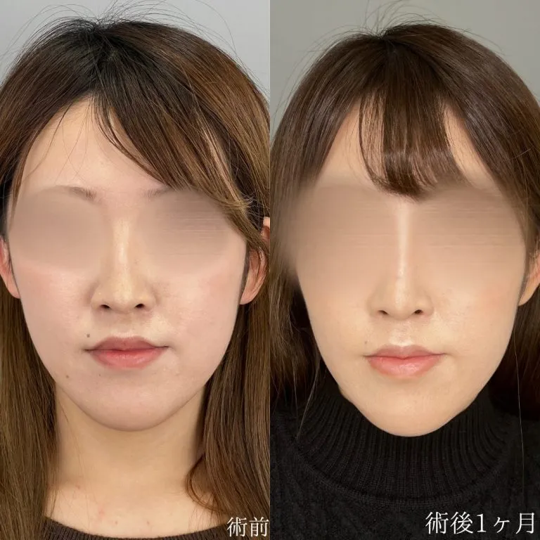 TCBの鼻整形の症例