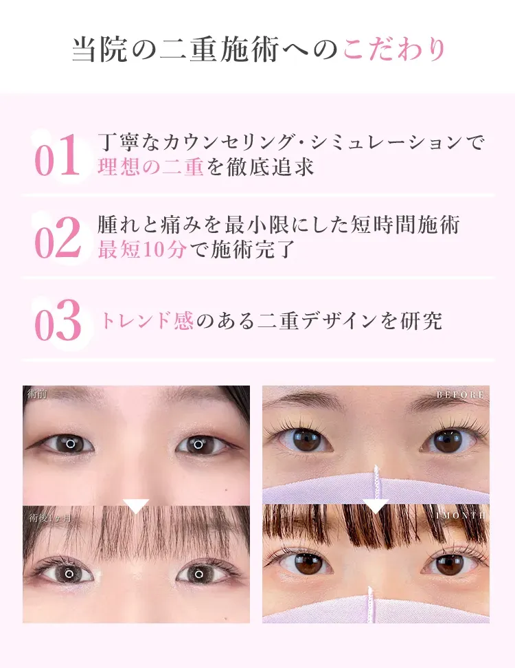 TCBの二重整形は3つのこだわりあり