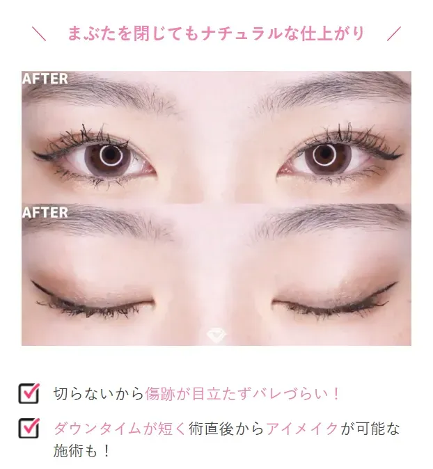 TCBの二重整形の症例写真